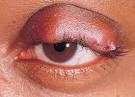 Category: <b>eye diseases</b>