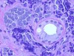 carcinoma <b>cellule di</b> Merkel21.