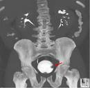 the <b>urinary bladder</b> (red