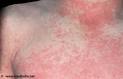<b>Rheumatic Fever</b>