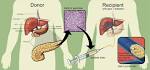 File:Islet <b>transplantation</b>