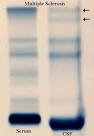 discrete <b>oligoclonal bands</b>