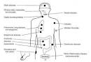 Common sites of <b>Bacteroides</b>