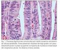 <b>adenoma velloso</b> extenso a