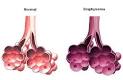 <b>EMPHYSEMA</b> CAUSES