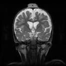 <b>Sinus pericranii</b>