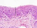 of <b>carcinoma</b> in <b>situ</b> (left