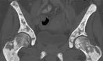 dense <b>osteosclerosis</b> could