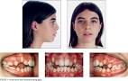 <b>Angle Class I malocclusion</b>