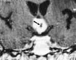 Chordoid Glioma: A <b>Neoplasm</b>