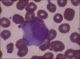 <b>Mononucleosis infecciosa</b> #