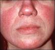 <b>rosacea</b> is
