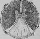 <b>Tabes Dorsalis</b> (Collins).
