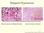 <b>Malignant Hypertension</b>