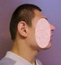 <b>Microcephaly</b>