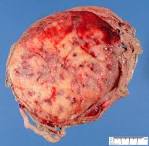 <b>placental diseases</b>