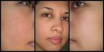 Jenn's <b>Rosacea</b> and sun damage