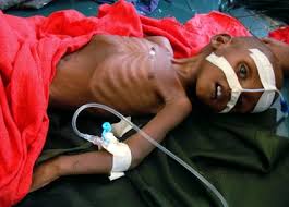 صور أطفال الصومال .. وهم يستغيثون Images?q=tbn:ANd9GcQm_xfF29IJG9PlSeS0CYQ1VggIPXaliNEnRQmqkOPguaa_ZmVI