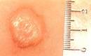 A <b>Tuberculin</b> "wheal" forms on