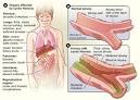 What Are the Signs and Symptoms of CYSTIC FIBROSIS? - NHLBI, NIH