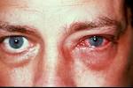 <b>eye infection</b>