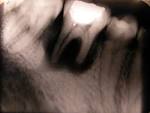 File:<b>Root resorption</b>.JPG