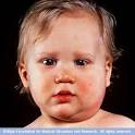<b>Mumps</b>