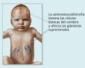 <b>La</b> adrenoleucodistrofia una <b>enfermedad</b>, un legado y las tristes