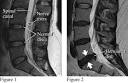 HERNIATED DISC Recovery