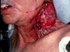 Recurrent Squamous Cell Carcinoma of the Neck
