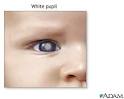 White spots in the pupil: MedlinePlus Medical Encyclopedia Image