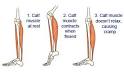 <b>Muscle Cramp</b>