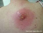 the <b>abscess</b> may form Root