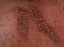 (<b>condylomes acuminés</b>).