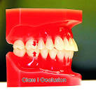 <b>Class I</b> Occlusion
