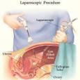 <b>Laparoscopy</b> is performed under