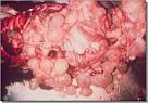 Hydatid <b>cysts</b>