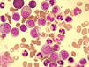 A <b>leucemia</b> mielóide <b>crônica</b>