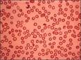 <b>Talasemia</b> menor
