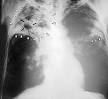 advanced <b>tuberculosis</b>.