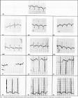 Arquivos Brasileiros de Cardiologia - Patent ductus arteriosus and
