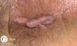 <b>Condylomes acuminés</b>