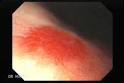 Gastric <b>Angiodysplasia</b>.
