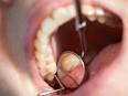 de câncer de <b>boca</b> – <b>doença</b>