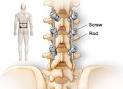 In lumbar <b>spinal fusion</b>,