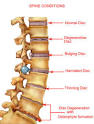 SPINAL STENOSIS Pictures, SPINAL STENOSIS Image, Medical Photo Gallery