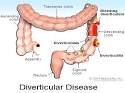 infection (diverticulitis)