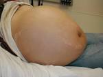 <b>Ascites</b>