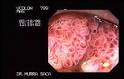 Large villous <b>adenoma</b> of the