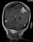 <b>Meningioma</b>